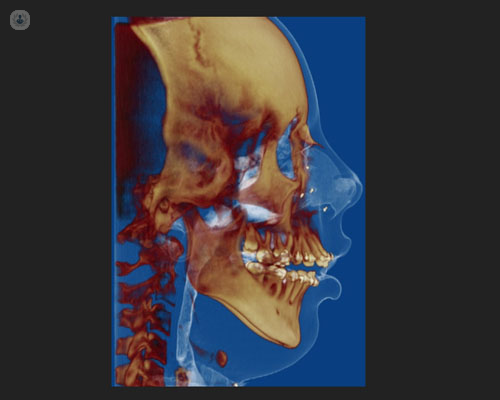 La cirugía ortognática permite corregir los problemas de mandíbula y devolver la simetría al rostro - Top Doctors