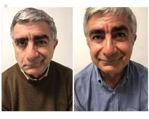 Antes y después del tratamiento de parálisis facial - Top Doctors