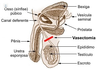 vazectomia és prostatitis)