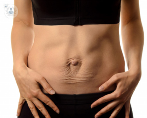 Primer plano de un abdomen con diástasis abdominal | Top Doctors