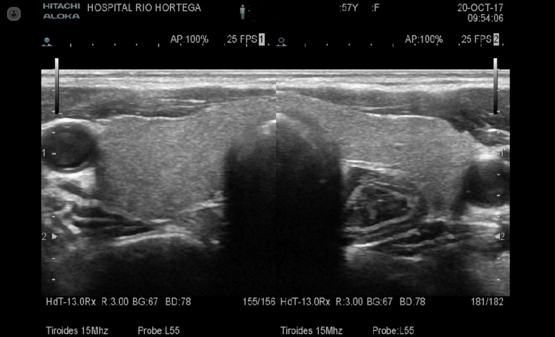 Imagen de una ecografía de tiroides