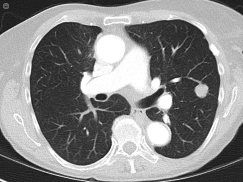 Nódulo pulmonar | Top Doctors