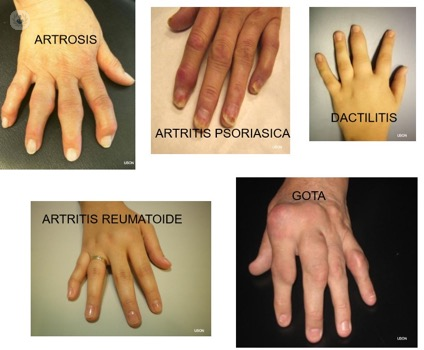 piso metodología evolución El ABC de la Artritis | Top Doctors