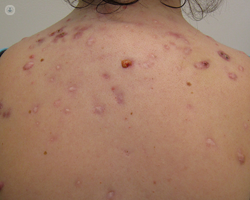 Las cicatrices del acné se producen a la hora de curar las heridas tras la inflamación