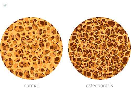 imagenes osteoporosis