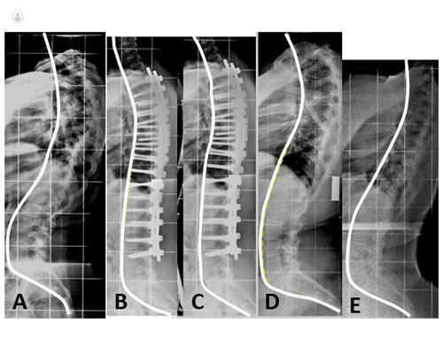 Radiografías de columna de paciente del doctor Burgos con escoliosis - by Top Doctors