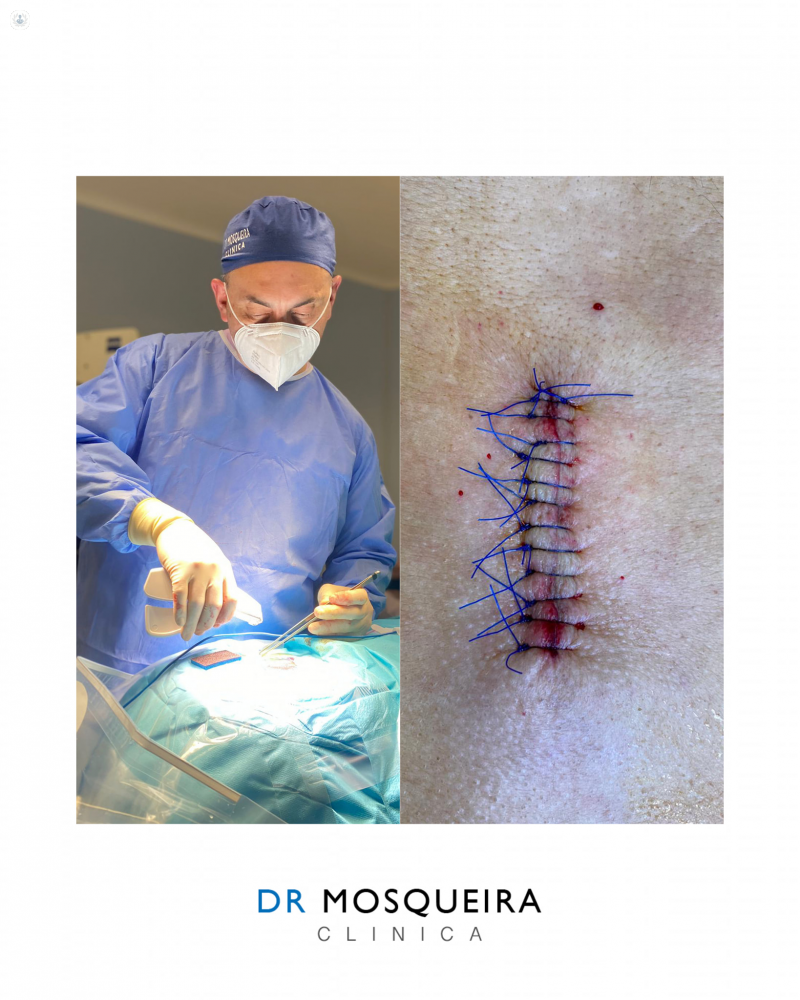 Cicatriz tras cirugía de estenosis de canal