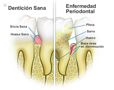 Representación de la enfermedad periodontal