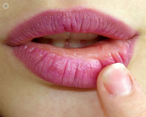 Boca de mujer que dobla el labio inferior ligeramente para mostrar un afta o llaga bucal - by Top Doctors