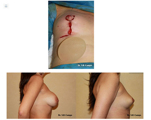 Fotografías del antes y después de la técnica de mamoplastia del Dr. Rodríguez-Camps by Top Doctors