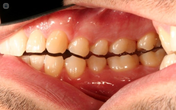 Solución al desgaste de los dientes por bruxismo