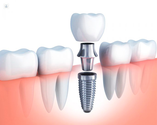 Eficacia de los implantes dentales