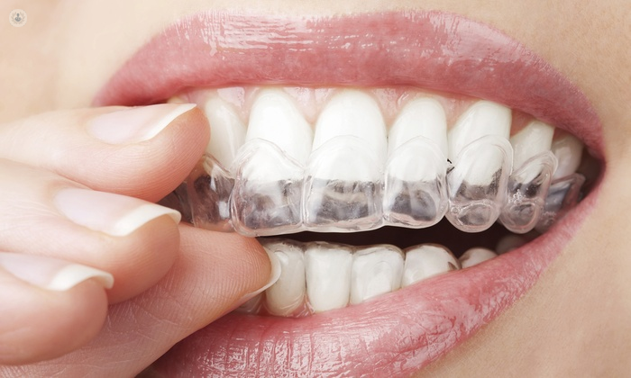 Qué es una férula dental?