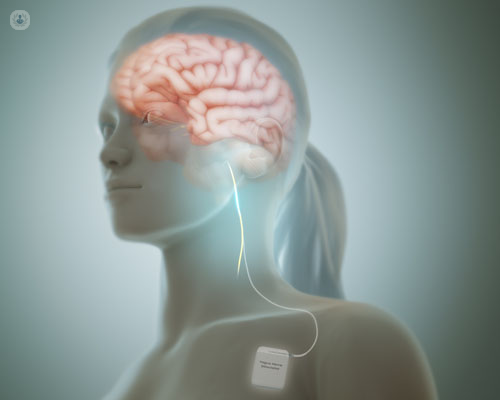 Simulación de estimulación craneal con un maniquí mujer - estimulación cerebral epilepsia - by Top Doctors