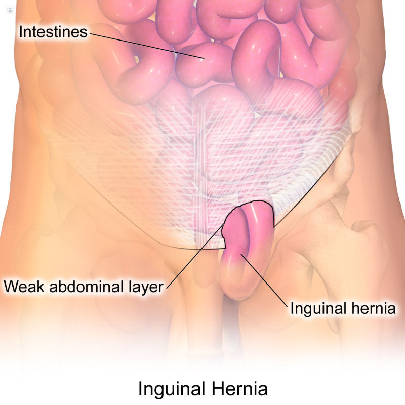 Hernia inguinal laparoscopia |