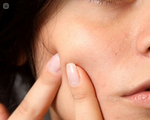 Por qué no puedes petar los granitos del acné | Top Doctors