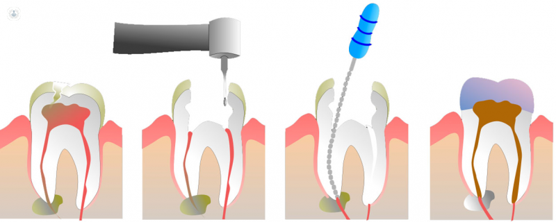 Ejemplo del funcionamiento de la endodoncia