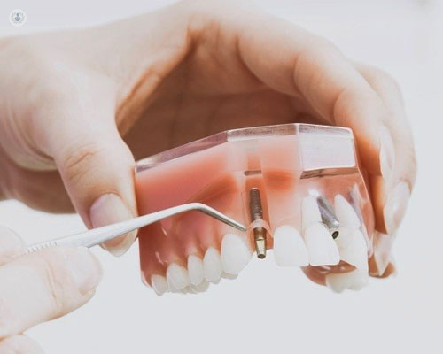 Primer plano de una maqueta de una dentadura con implantes dentales - implantología - by Top Doctors