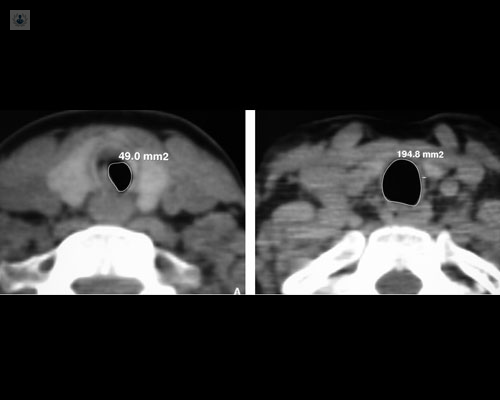 Radiografía que muestra el estrechamiento de la tráquea - estenosis traqueal - by Top Doctors