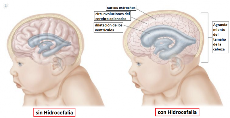 Ejemplo de niño sin y con hidrocefalia