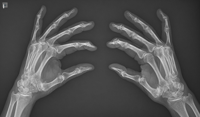 Artrosis de manos: la artrosis de los dedos • Doctor Laredo - Toledo