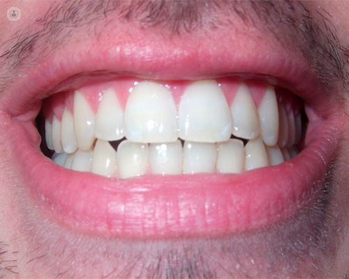 Bruxismo  Cómo tratar el apretamiento y rechinar de los dientes