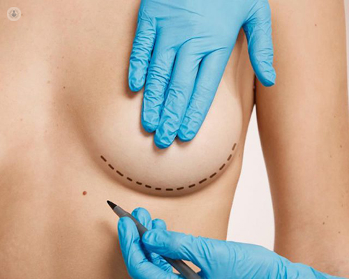 Imagen mostrando el pecho de una mujer y unas manos médicas haciéndole unas marcas - reconstrucción mamaria by Top Doctors