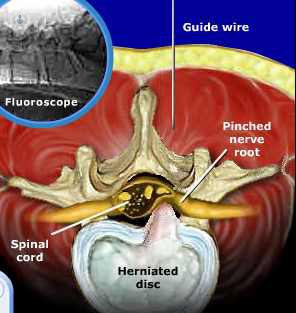 hernia lumbar comprimiendo nervio by Top Doctors
