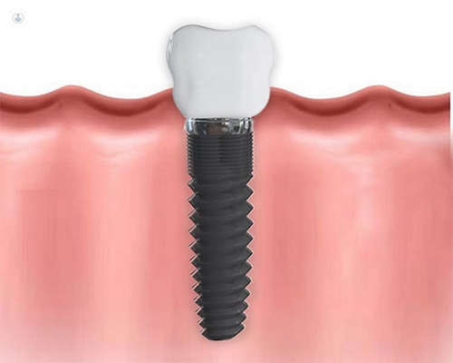Estructura de un implante dental