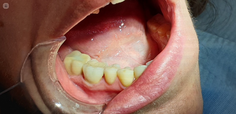 Cuánto dura una corona dental?