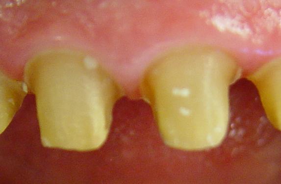 preparación coronas dentales